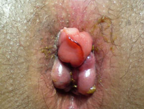 anal-itch