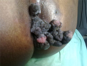 anal warts