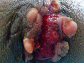 hemorrhoids