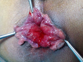 piles or hemorrhoids