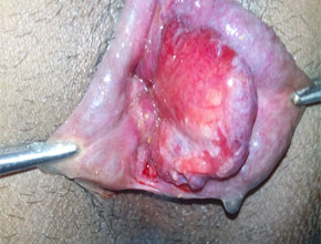 piles or hemorrhoids