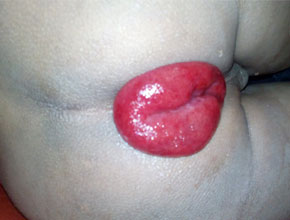 prolapse rectum
