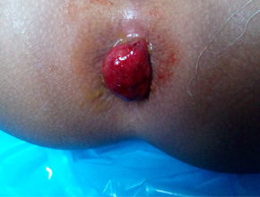 prolapse rectum