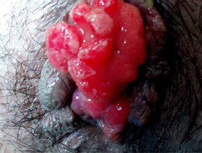 prolapse rectum