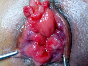 prolapse rectum