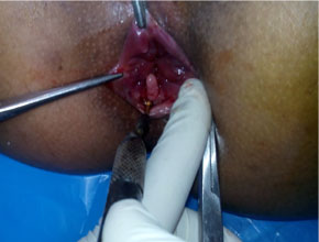 radio frequency abalation of anal polyp